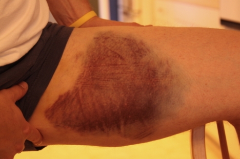The bruise as it first appeared, 3 days after the injury.
