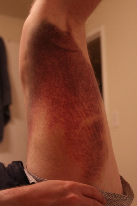 The bruise after a week of interacting with gravity.